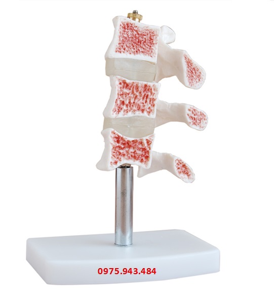 Mô hình bổ dọc chứng loãng xương XC-134